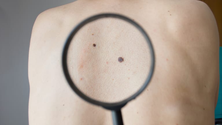 Stop Skin Cancer: Before It’s More Than Skin Deep