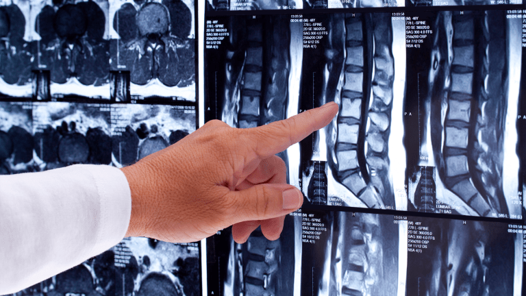 More than A Bit of Back Pain: Ankylosing Spondylitis 