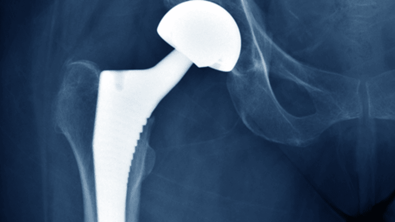 Understanding Joint Replacement - Is a new joint the answer to your pain?