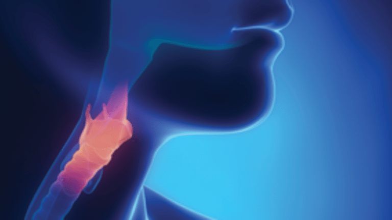 Are You at Risk? Understanding Barrett’s Esophagus