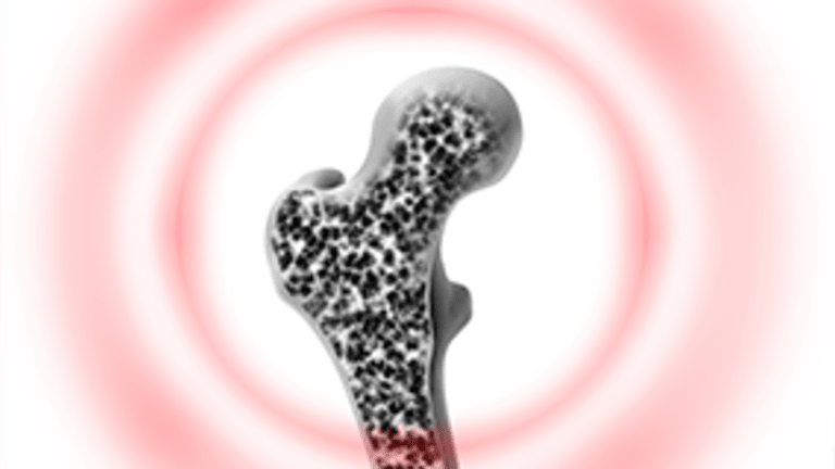 Osteoporosis