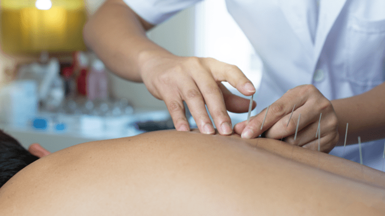Can Acupuncture Cure Your Pain?