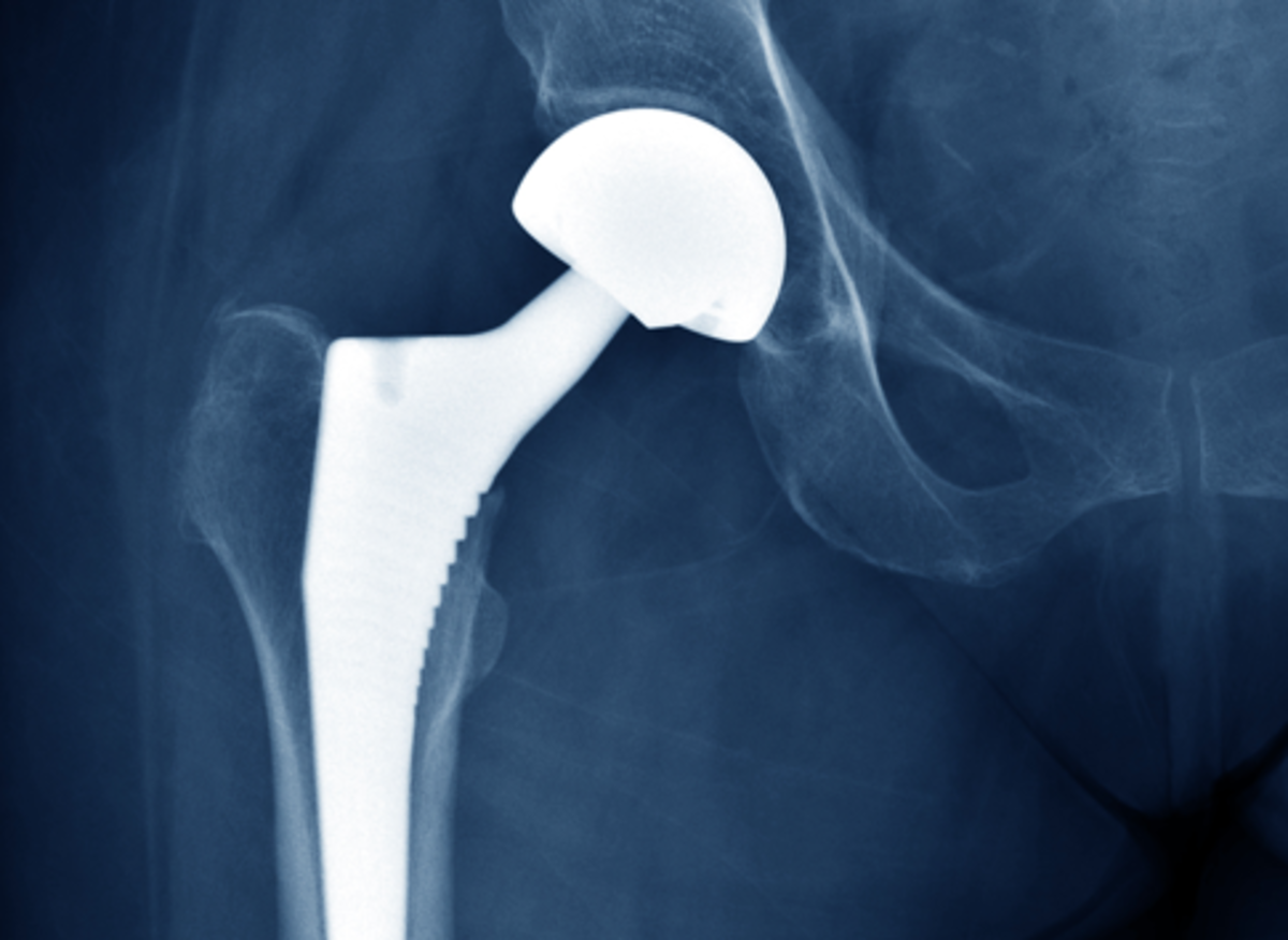 Understanding Joint Replacement - Is a new joint the answer to your ...